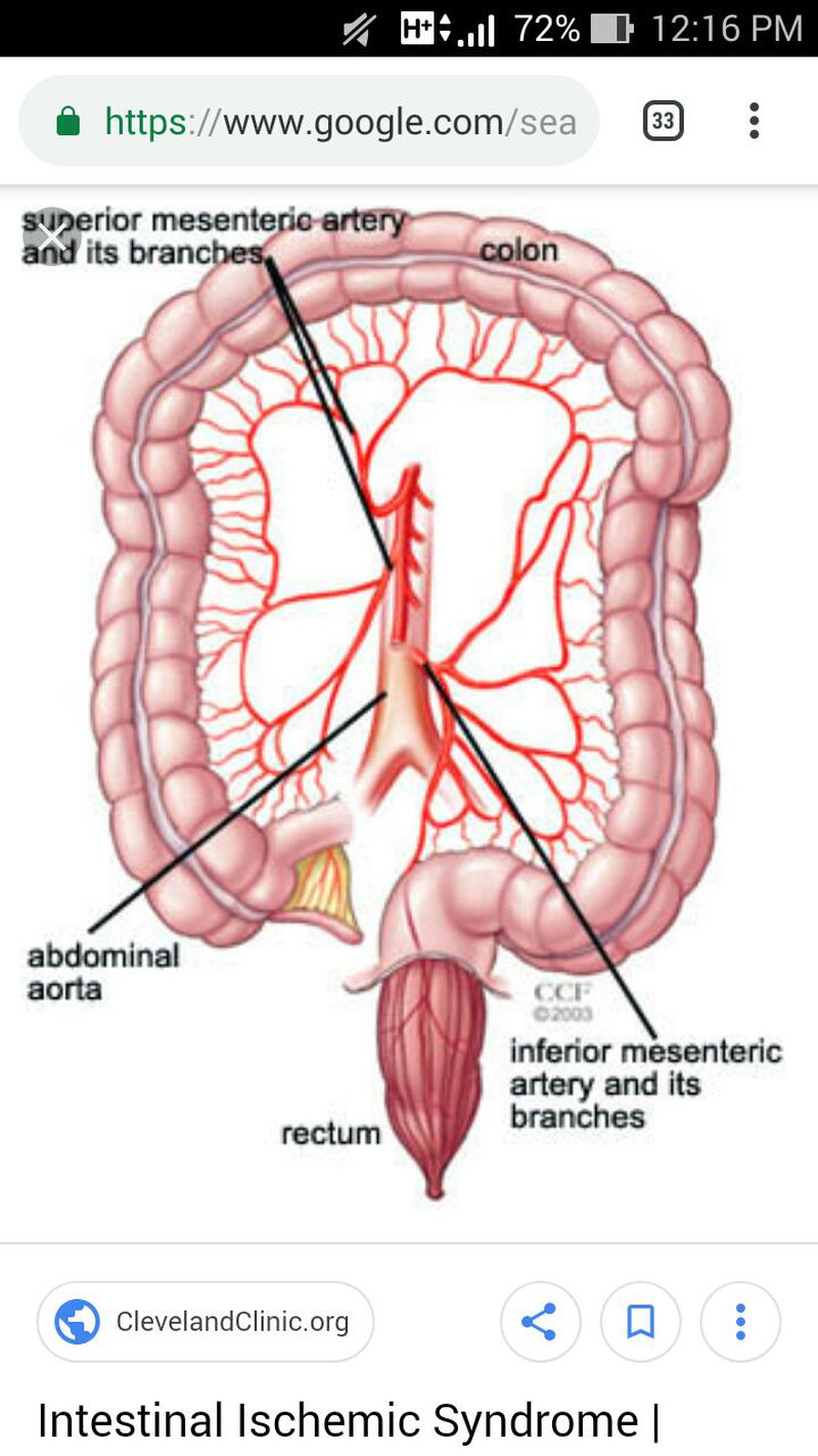 Мезентериальная ишемия. Мезентериальная брыжейки. Мезентериальные сосуды атеросклероз. Мезентериальная эмболия ишемия кишечника. Тромбоз мезентериальных вен.