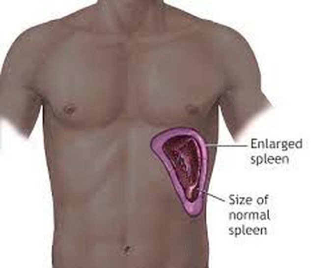 Splenomegaly