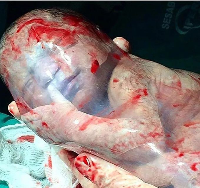 En Caul Birth