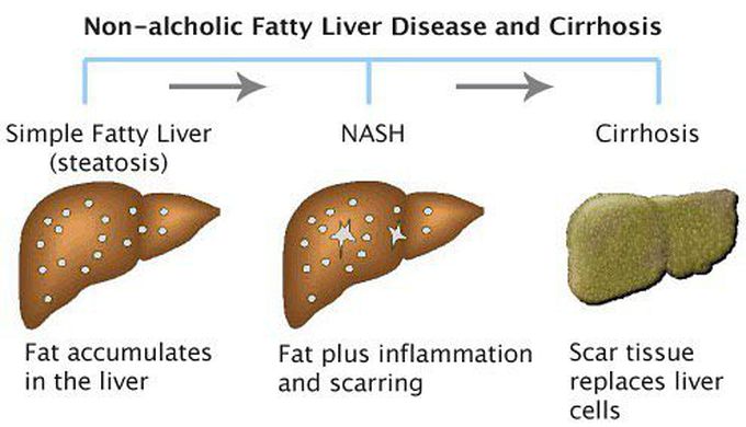 Nonalcoholic fatty liver disease