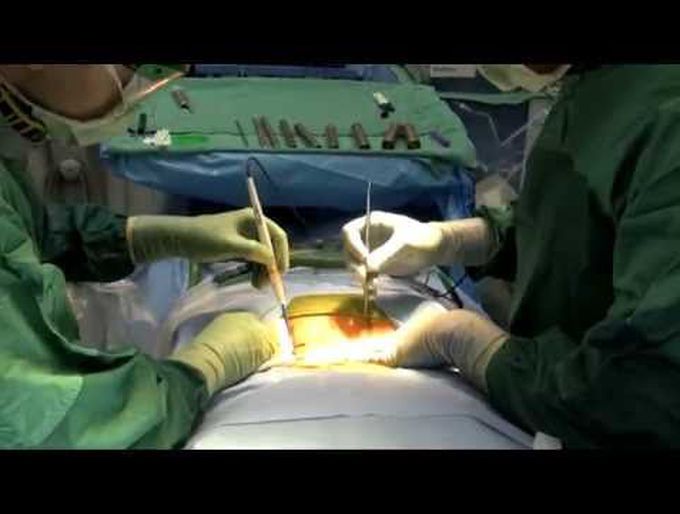 Minimally invasive TLIF with percutaneous navigated guidewireless lumbosacral pedicle screw fixation