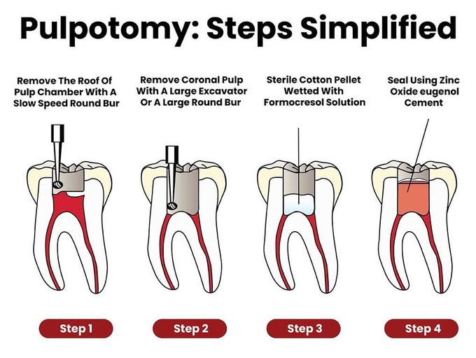 Pulpotomy