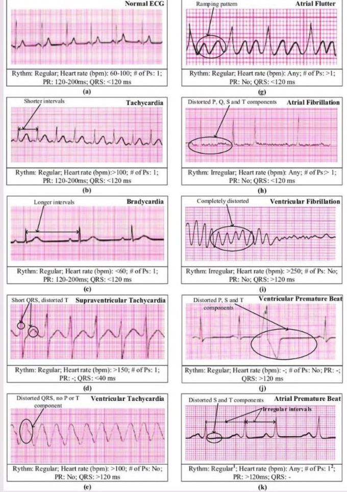 Normal and Abnormal ECG