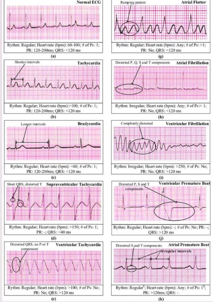 normal vs abnormal ecg