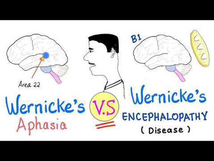 Wernicke’s Aphasia VS Wernicke's Encephalopathy | Neuro