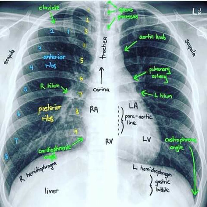 Basic Chest X-Ray