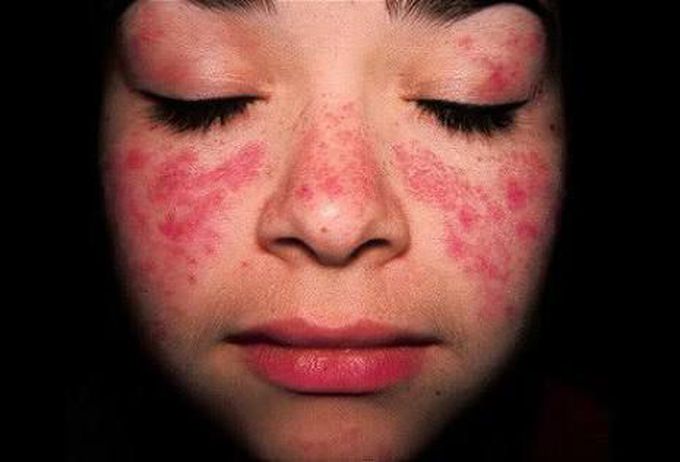 Name the rash.