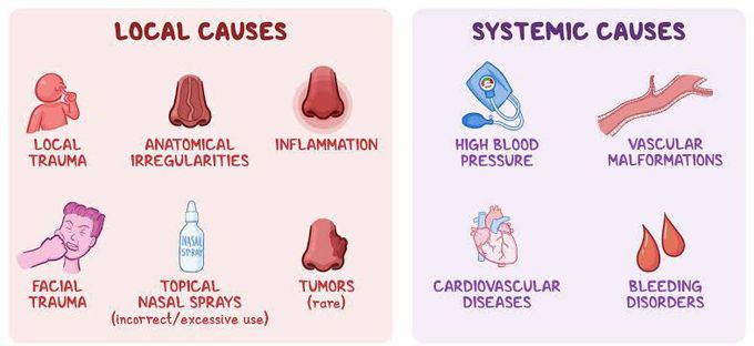 Here is a comparison between local and systemic causes of nosebleed