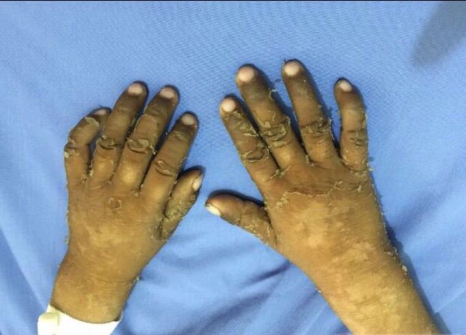 #Case

9 years old boy presented with dry scaly lesions since early childhood, associated with developmental delays, intellectual disability, impaired speech & motor abilities along with LL flexion contracture.

What is the diagnosis?? 🤔
👇🏽👇🏽