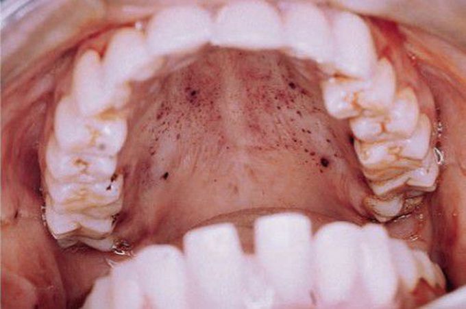 Petechiae , blood dyscrasia