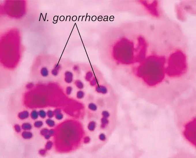 Neisseria gonorrhoeae