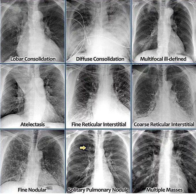 Lung Pathologies on CXR
