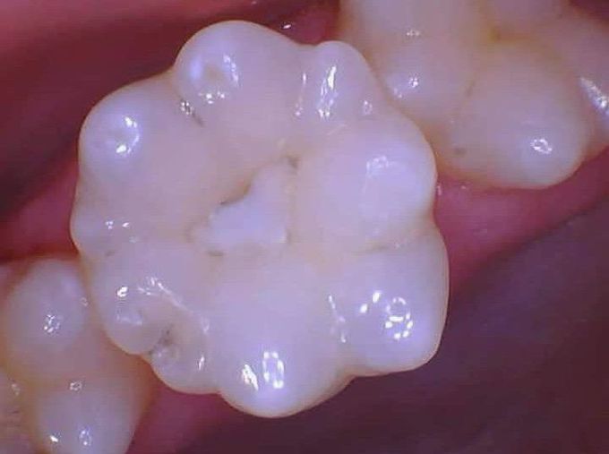 Mulberry molars