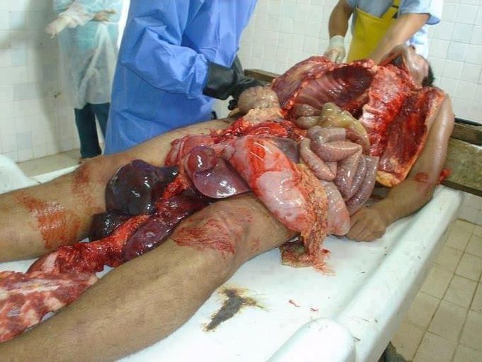 Autopsy of human body