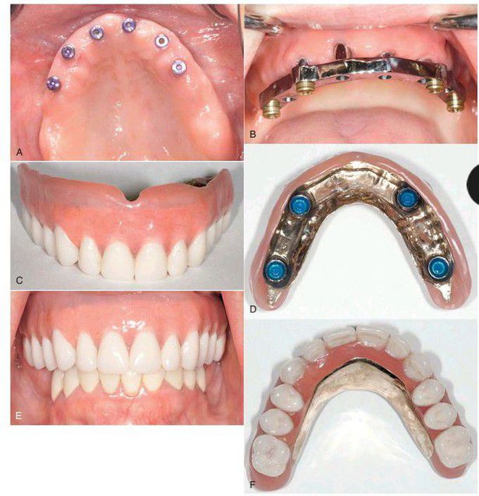 Implant supported overdenture