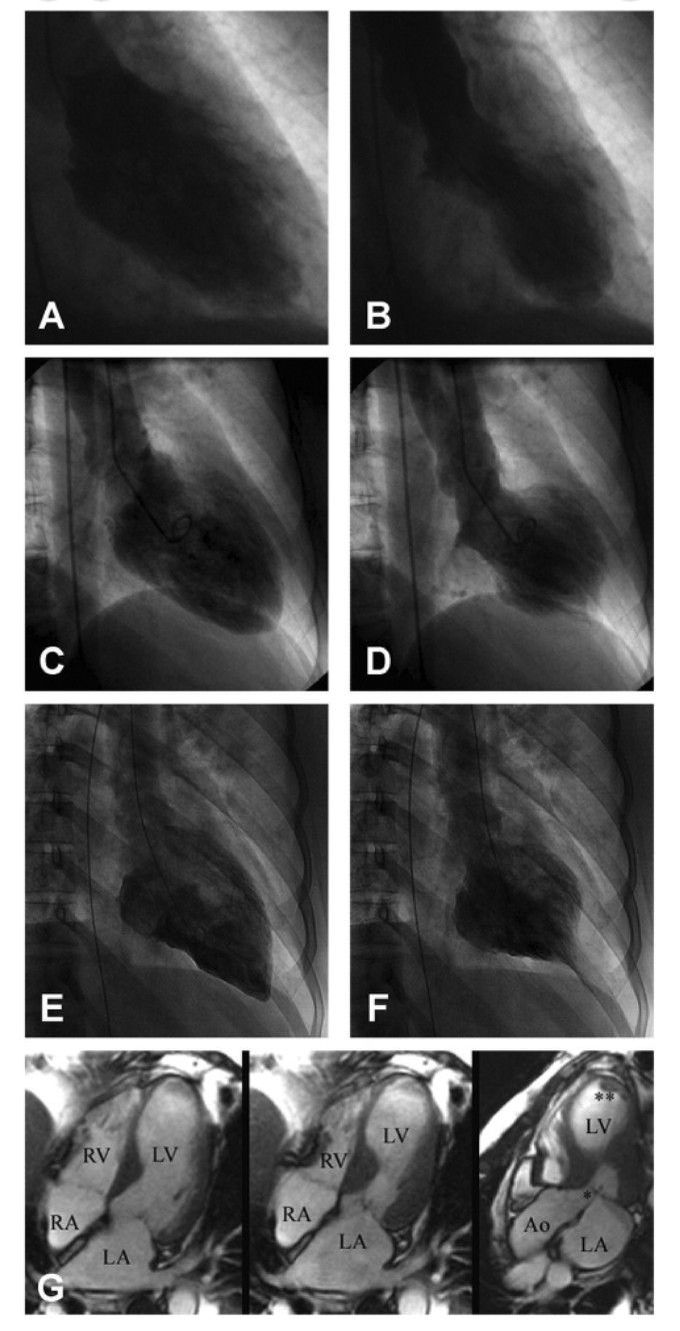 Takotsubo cardiomyopathy 💔