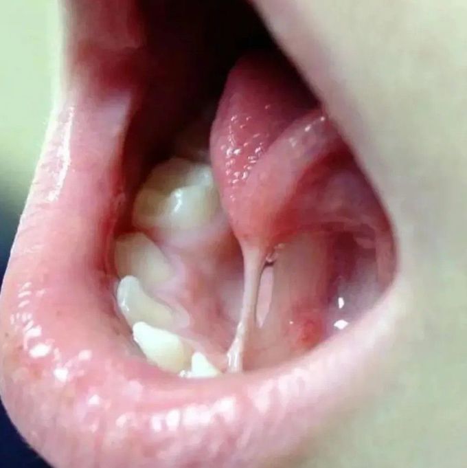 Ankyloglossia