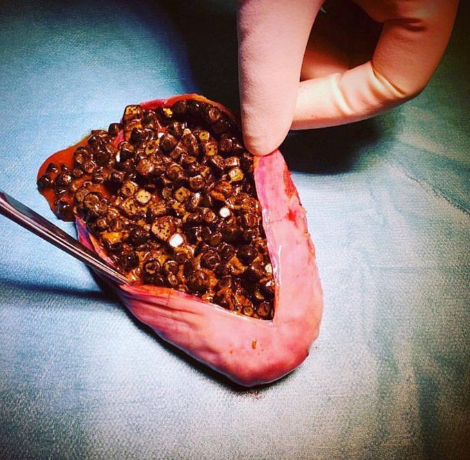 Gallbladder.