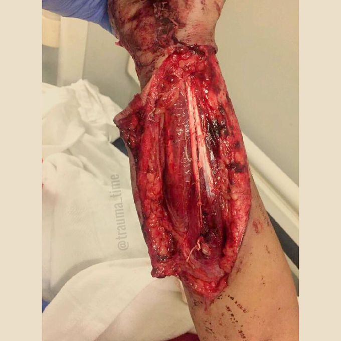 Traumatic Forearm Degloving