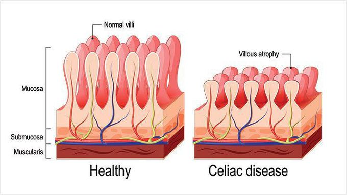 Celiac Disease