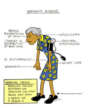 Addison's Disease - Medizzy