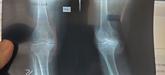 Osteoarthritis