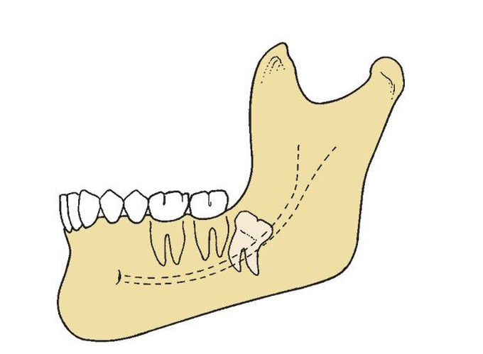 Difficult impaction case