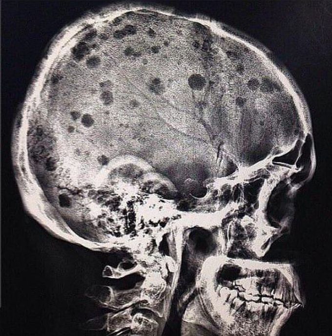 Multiple myeloma