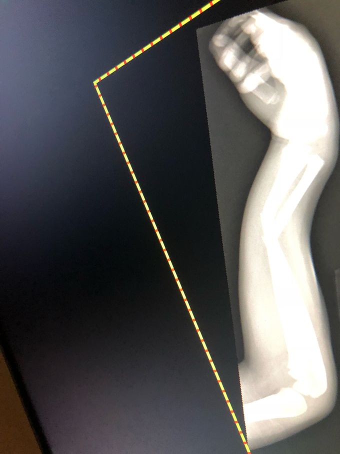 Radius and Ulna Fracture