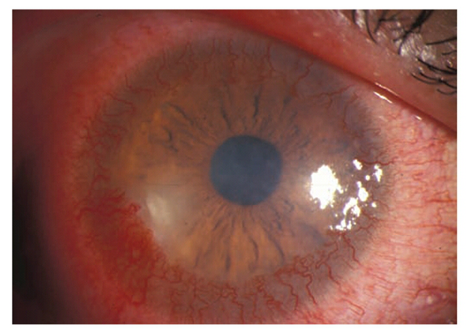 Corneal neovascularization