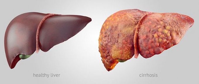 Signs and Symptoms of Chronic Liver Disease