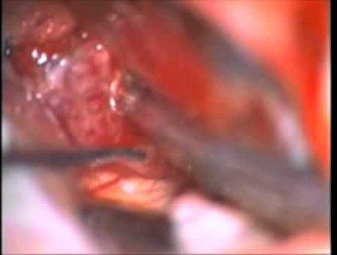 Retrosigmoid approach for resection of petroclival meningioma