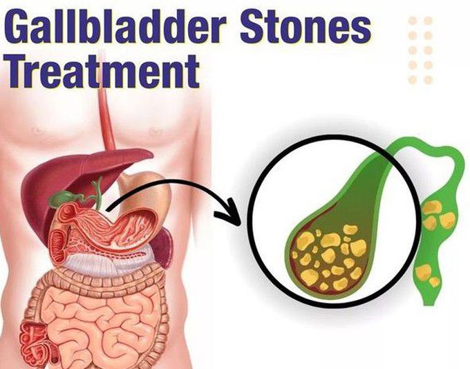 Cholelithiasis Treatment