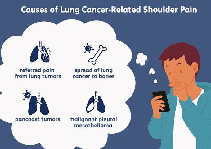 These are the causes of Lung cancer related shoulder pain