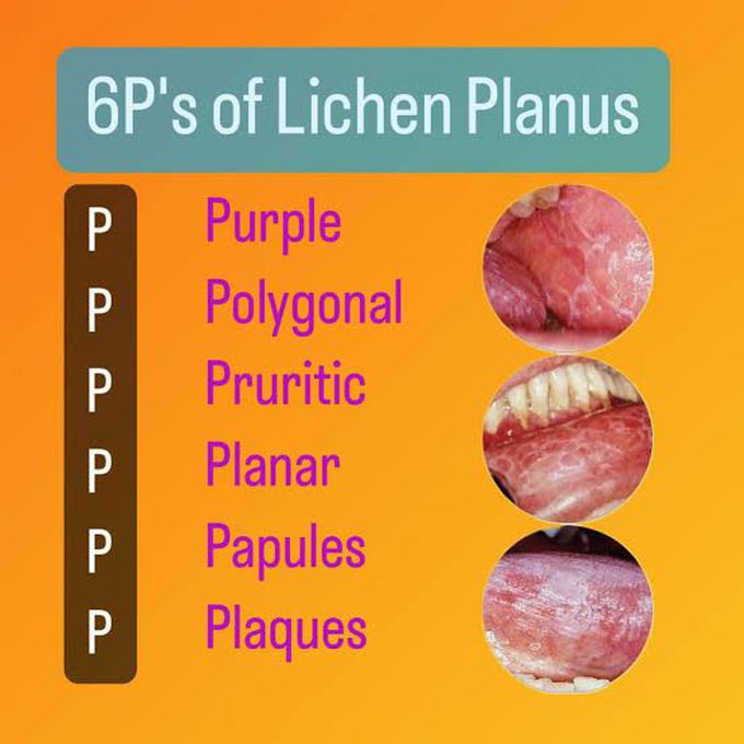 Clinical Features of Lichen Planus