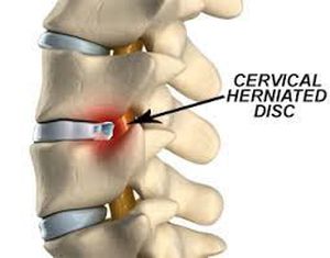 Herniated intervertebral disc - MEDizzy