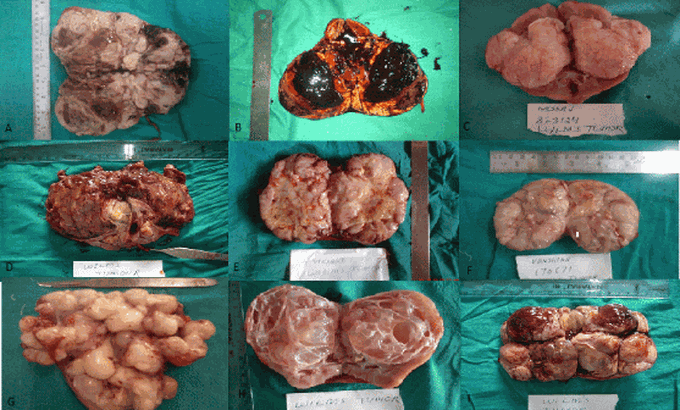 Signs and Symptoms of Wilms' Tumor