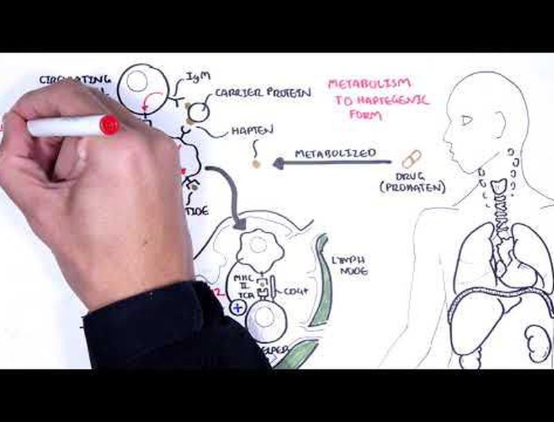 DRESS Syndrome - causes, pathophysiology, signs and - MEDizzy DRESS Syndrome - causes, pathophysiology, signs and - MEDizzy