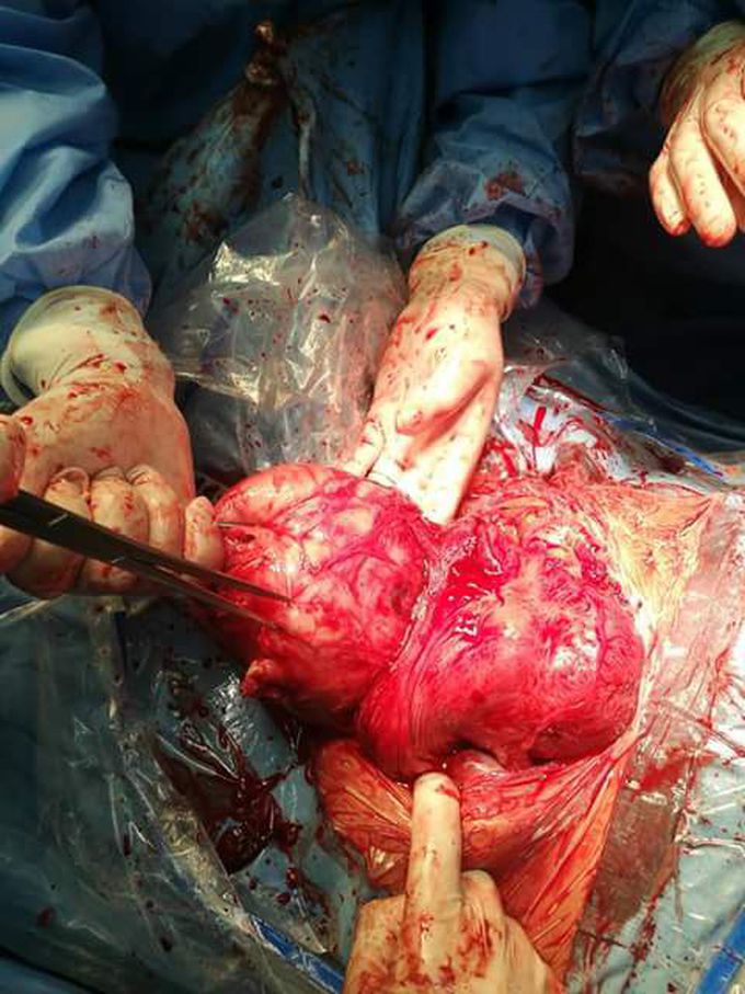 Fibroma