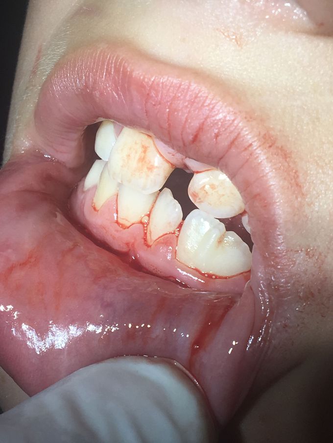 Kids tooth anomaly