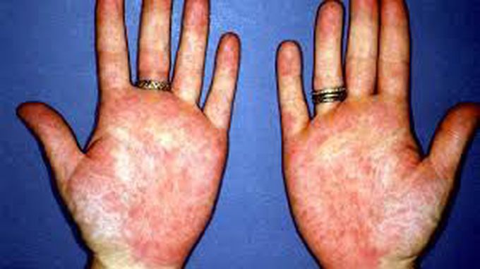 Palmar Erythema