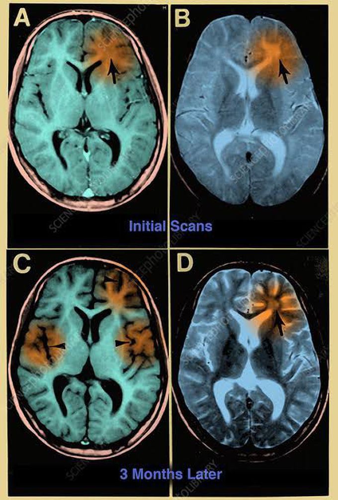 Subacute sclerosing panencephalitis (SSPE)