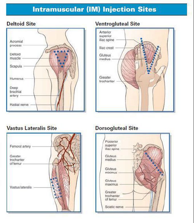 IM injection sites