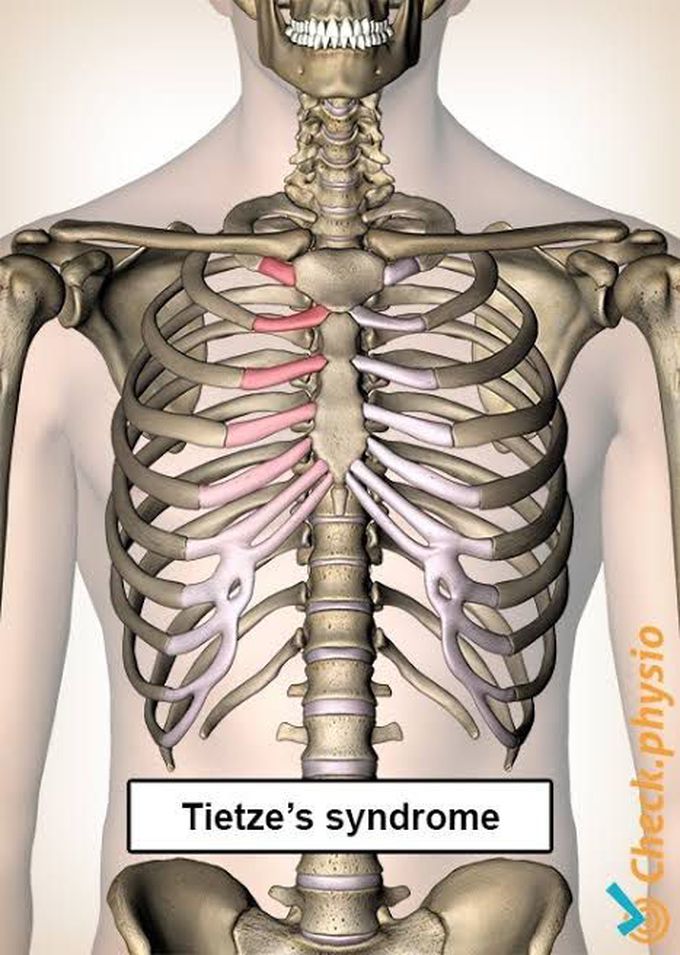 Tietze syndrome