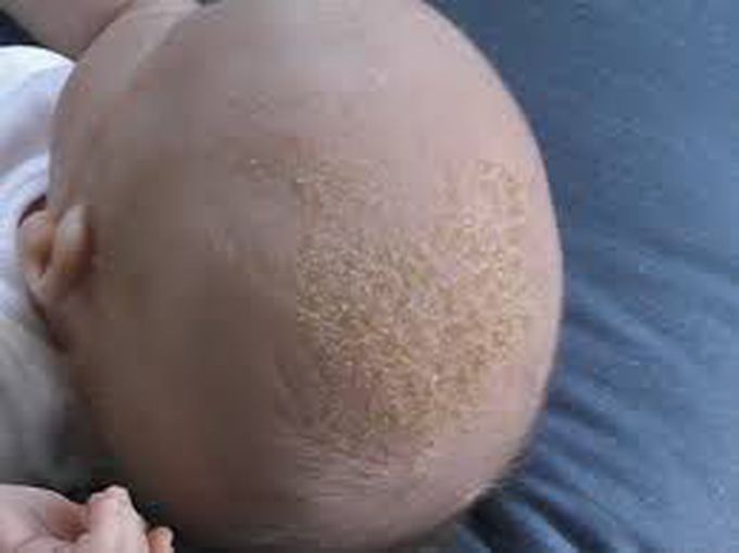 Causes of Cradle Cap