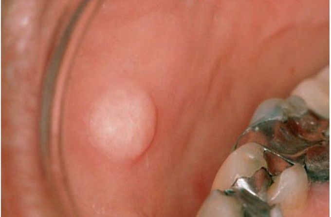 Oral fibroma