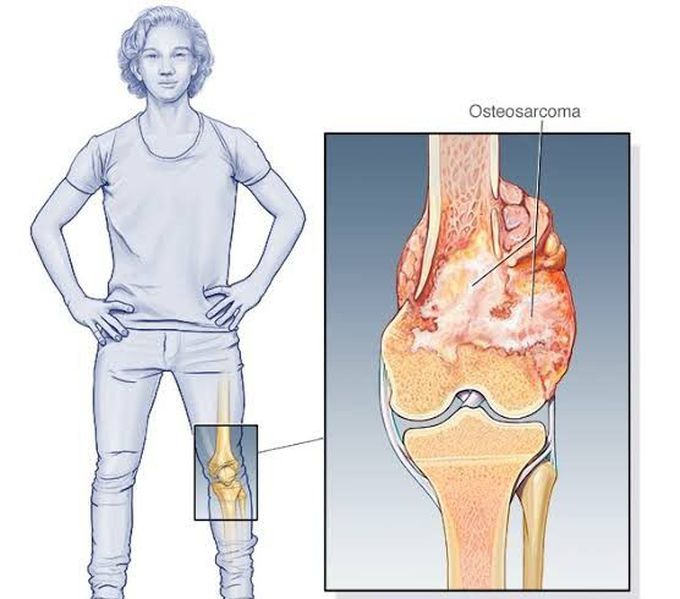 Osteosarcoma