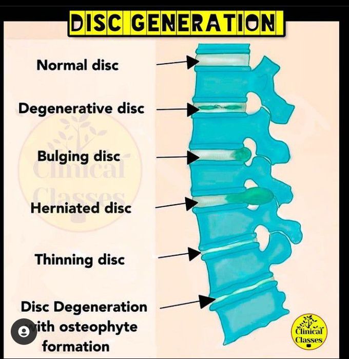 Disc degeneration