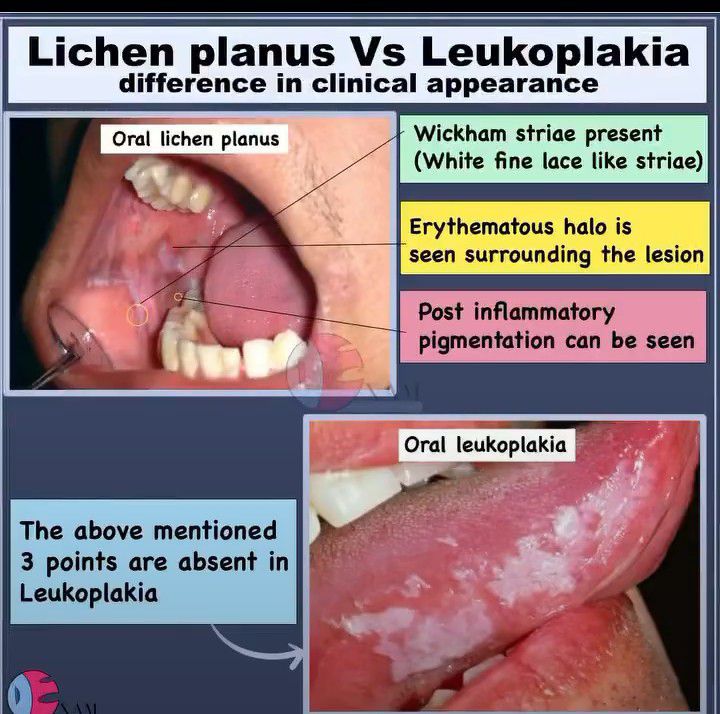 Lichen Planus Vs Leukoplakia - MEDizzy