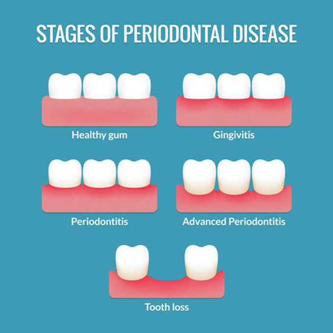 Tooth gum